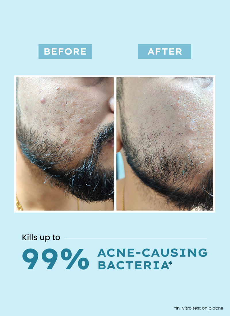 Clarifying Acne Cleanser with 2% Salicylic Acid - 100 ml