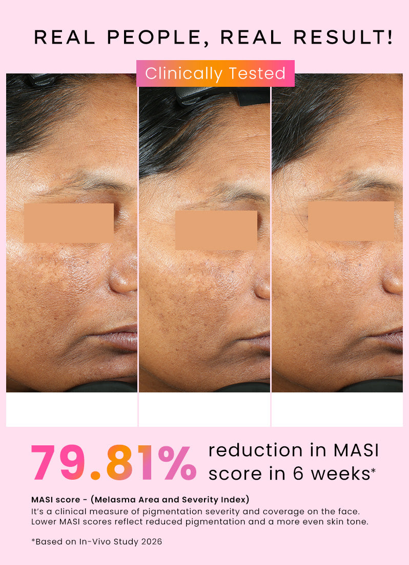 Dual Phase De-pigmentation Serum | 4% Tranexamic Acid- 30ml