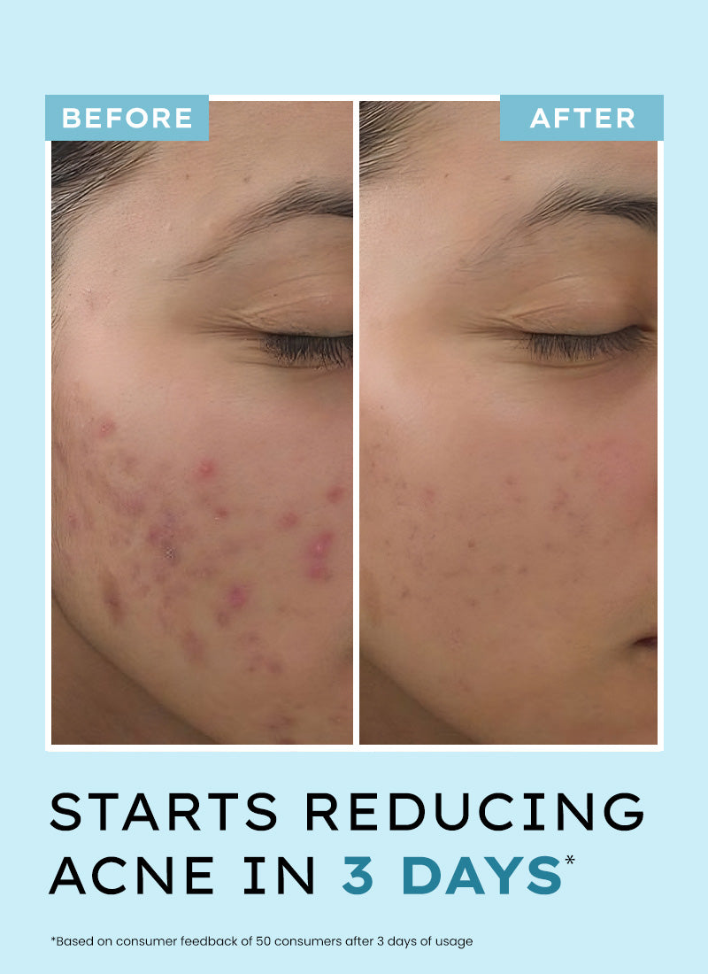 ANTI ACNE FACE SERUM WITH 10% AZELAIC ACID 2% SALICYLIC ACID & TEA TREE EXTRACT