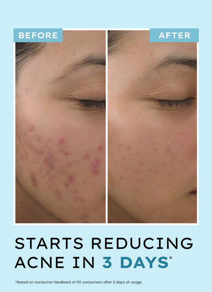 ANTI ACNE FACE SERUM WITH 10% AZELAIC ACID 2% SALICYLIC ACID & TEA TREE EXTRACT
