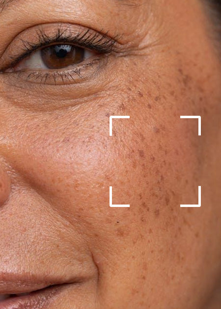 Shop By Concern - Dark spot & Pigmentation